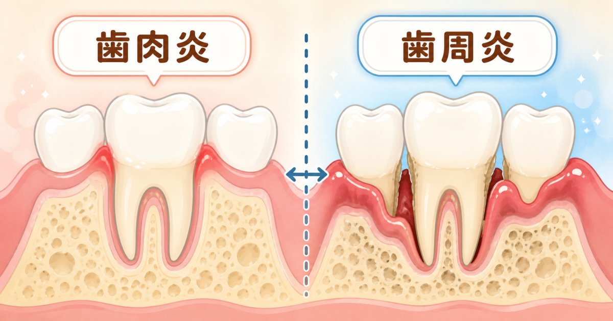 元に戻せる「歯肉炎」と骨に影響が及ぶ「歯周炎」の境界線