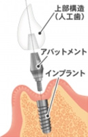 インプラントの構成